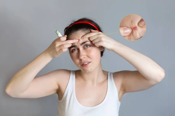 Teenage Girl Squeezes Pimples Her Forehead Holding Concealer Pencil Her — Stock Photo, Image