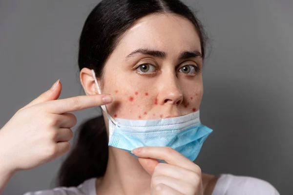 Maskne Portrait Young Caucasian Woman Shows Pimples Her Cheeks Wearing — Stock Photo, Image