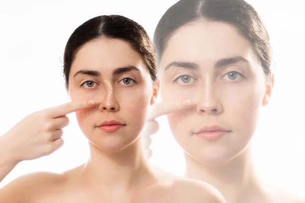 前と後のプラスチック製の鼻手術を比較 鼻の曲がった橋で若い白人女性のポイントの肖像画 白い背景に隔離されている 鼻形成術の概念 — ストック写真