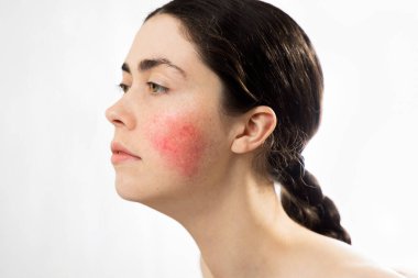 Couperose. Portrait of a young beautiful Caucasian woman with rosacea on her cheek. Isolated on a white background. The concept of cosmetology. clipart