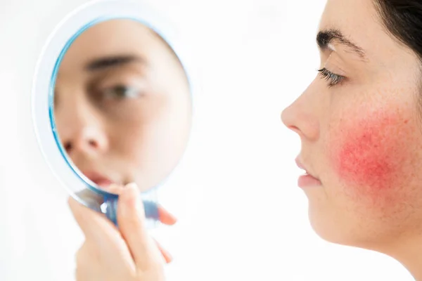 Couperose Young Beautiful Caucasian Woman Rosacea Her Cheek Looking Mirror — Stock Photo, Image