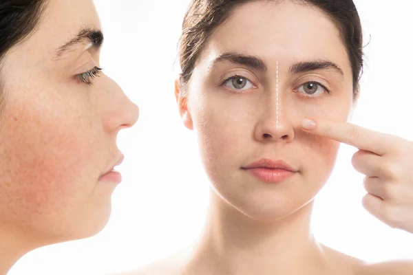 形成鼻手術前後の結果を比較します 若い白人女性の肖像画が彼女の鼻を指している 白い背景に隔離されている 鼻形成術の概念 — ストック写真