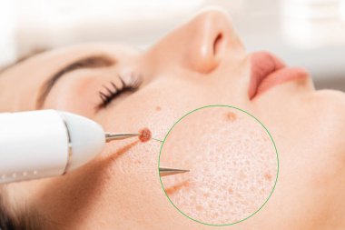 Elektropıhtılaşma ve lazer kozmetik. Kadın yüzünden doğum lekesinin çıkarılması. Dermatolog cerrah, beni çıkarmak için profesyonel bir elektrokoterapi kullanıyor. İşlemden önce ve sonra sonuçların karşılaştırılması.