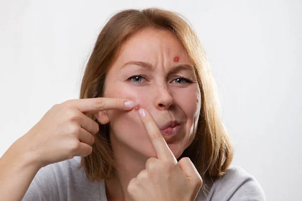 Medizin Und Kosmetologie Akne Porträt Einer Jungen Blonden Frau Mit — Stockfoto