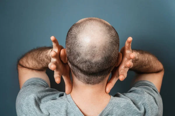 Homem Careca Sofrendo Por Causa Sua Aparência Pessoa Agarra Cabeça — Fotografia de Stock