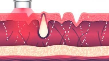 Laser treatment for wrinkles and acne. Skin rejuvenation spa procedure. Medical animation displays the process of collagen fibers rebuilding, the skin smoothing. Modern innovation dermatological anti-aging technology.