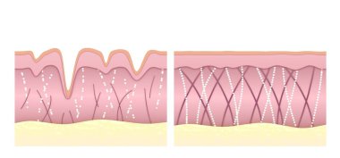 Collagen and elastin fibers in young and wrinkled skin comparison. The medical illustrations show results after anti-aging therapy or collagen-boosting cream. Comparison of age and young human skin.