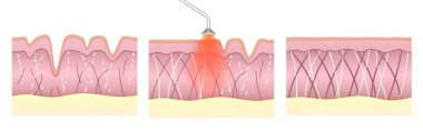 Laser skin resurfacing. Comparison of skin tissue before and after laser anti-aging treatment. Wrinkled irregular skin with poor collagen levels becomes smooth and elastic with strong regenerated collagen and elastin fibers.