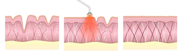 Laser skin resurfacing. Comparison of skin tissue before and after laser anti-aging treatment. Wrinkled irregular skin with poor collagen levels becomes smooth and elastic with strong regenerated collagen and elastin fibers.