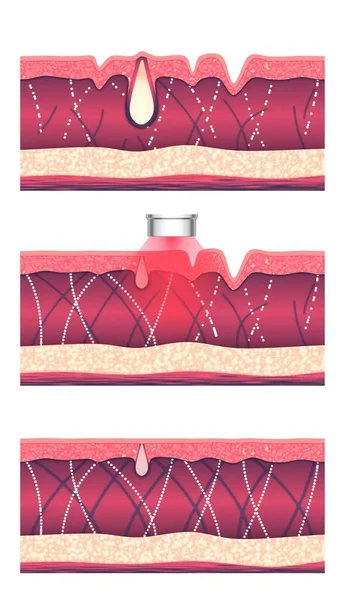 Laser skin resurfacing therapy. Wrinkle reduction and acne treatment process. Step-by-step illustration. Skin tissue before and after cosmetology procedure.