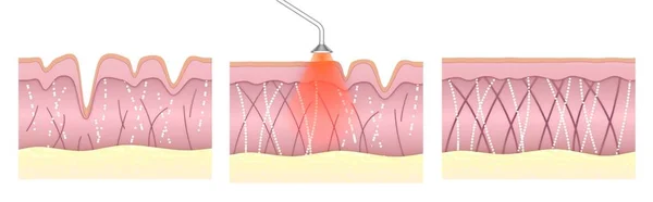 Laser Skin Resurfacing Comparison Skin Tissue Laser Aging Treatment Wrinkled 스톡 사진