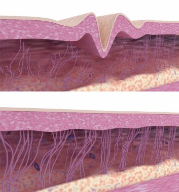 Skin rejuvenation. Collagen and elastin fibers rebuilding. 3D rendered illustration. clipart