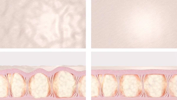 Cellulite skin before and after anti-cellulite treatment. 3d render