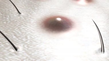 Ingrown hair treatment process. Skin with inflamed hair follicles before and healthy skin after the action drop of remedy medicine. Realistic medical 3D  animation