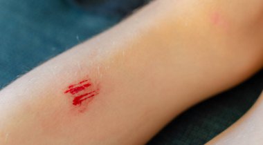 Bir çocuğun bacağında kan olan taze bir bacak. Kapat..