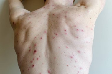 Vücudunda büyük noktalar ve sivilce sivilceleri var. Suçiçeği olan yetişkin vücudu. Suçiçeği, Varicella, Varicella Zoster virüsü olan bir adam..