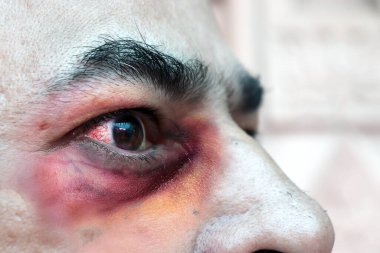 Kara mantar hastalığı olarak bilinen mukoza enfeksiyonuna yakalanmış ve Hindistan 'daki insanları etkileyen erkek gözlerinde kırmızı kan konjonktiviti görülüyor. Belirtiler ve tedavi.
