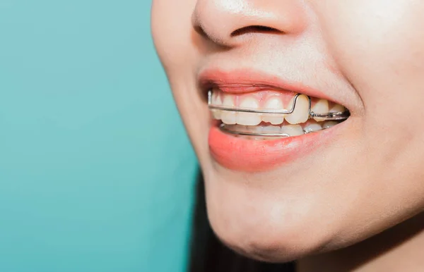 Denti Bianchi Vicino Della Giovane Asiatica Bella Donna Sorridente Indossano — Foto Stock