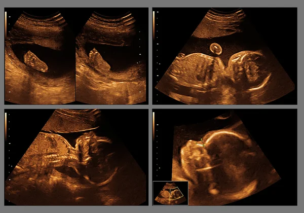 Baby x-ray ultrasound — Stock Photo, Image