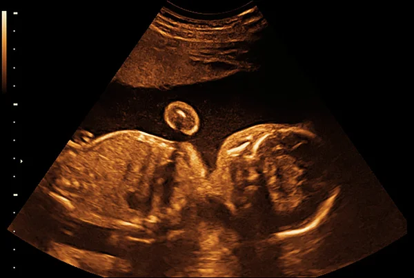 Baby x-ray ultrasound — Stock Photo, Image