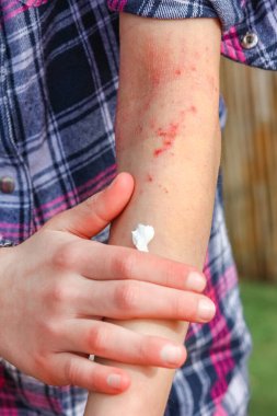 Bir çocuğun ellerinde atepik deri iltihabı.