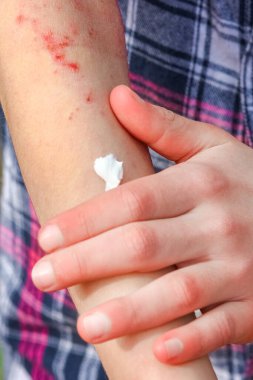 Bir çocuğun ellerinde atepik deri iltihabı.