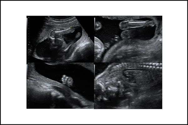 Ultraschallbild Eines Babys — Stockfoto