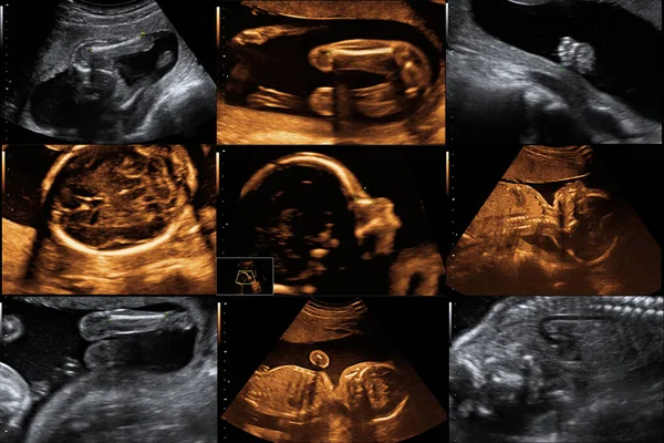 Many Ultrasound Picture Baby Child — Stock Photo, Image