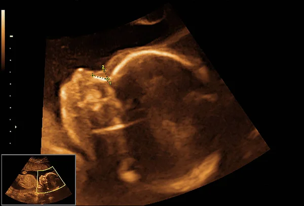 Imagen Ultrasonido Bebé — Foto de Stock