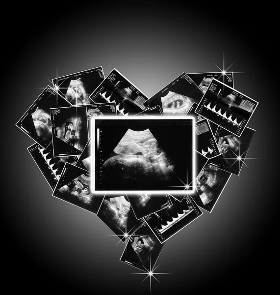 Baby embryo in de baarmoeder — Stockfoto