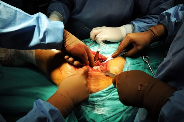 Substituição da anca no hospital — Fotografia de Stock