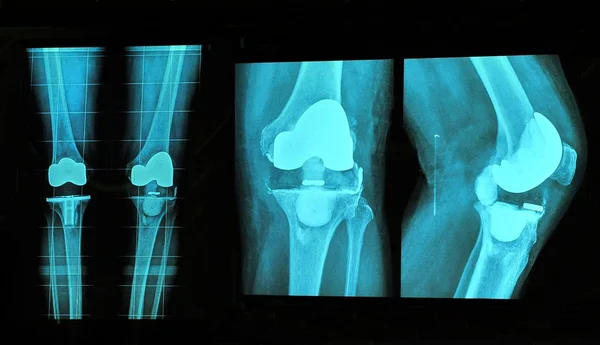 Knee replacement xray — Stock Photo, Image