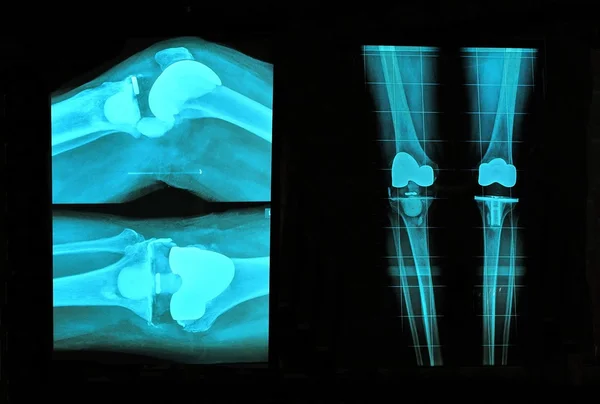Knie-Ersatz-Röntgen — Stockfoto
