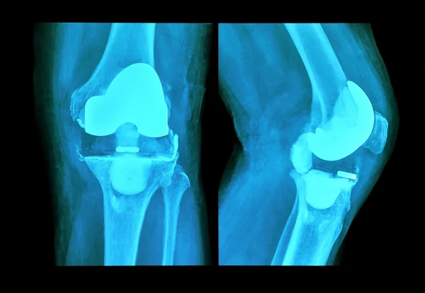 Prótese de joelho de raio-x — Fotografia de Stock