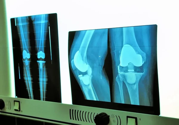 Prothèse de genou à rayons X Image En Vente