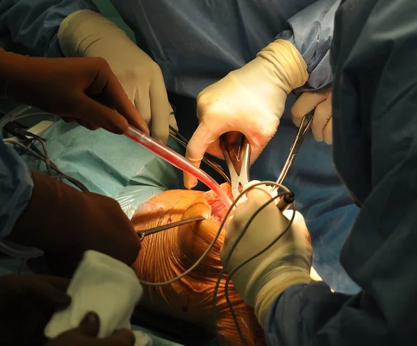 Prótesis de la operación del hospital de rodilla —  Fotos de Stock