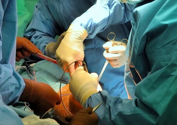 Protesi dell'intervento ospedaliero al ginocchio — Foto Stock