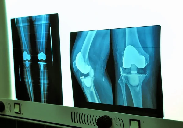 Prothèse de genou à rayons X Photos De Stock Libres De Droits