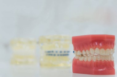 Dental model of invisible dental device to showcase to the customer.