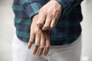 Kaşınan el derisinden muzdarip bir adam; alerji, isilik, mantar, tinea problemi, cilt bakımı, cilt bakımı, dermatoloji konsepti, yetişkin siyahi Afrikalı erkek modeli ile derisini kaşıyan hasta Afrikalı bir adam.