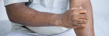Kaşınan kol derisinden muzdarip bir adam, alerji, kızarıklık, mantar, tensel doku problemi, cilt bakımı, cilt bakımı, dermatoloji konsepti, yetişkin Afrikalı adam modeli,