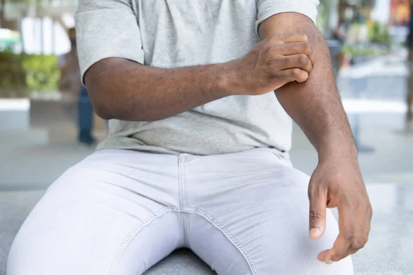 Man scratching suffering from itching arm skin; sick African man scratching his skin with allergy, rash, ringworm, tinea corporis problem; skin care, dermatology concept; adult black African man model