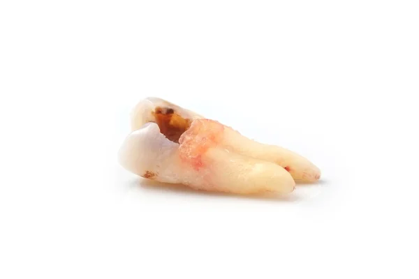 Próchnica zębów na białym na białym tle — Zdjęcie stockowe