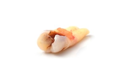 diş çürüğü beyaz arka plan üzerinde izole.