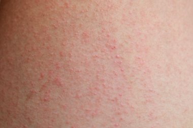 Hastanın Alerjik Dermatit döküntü cilt