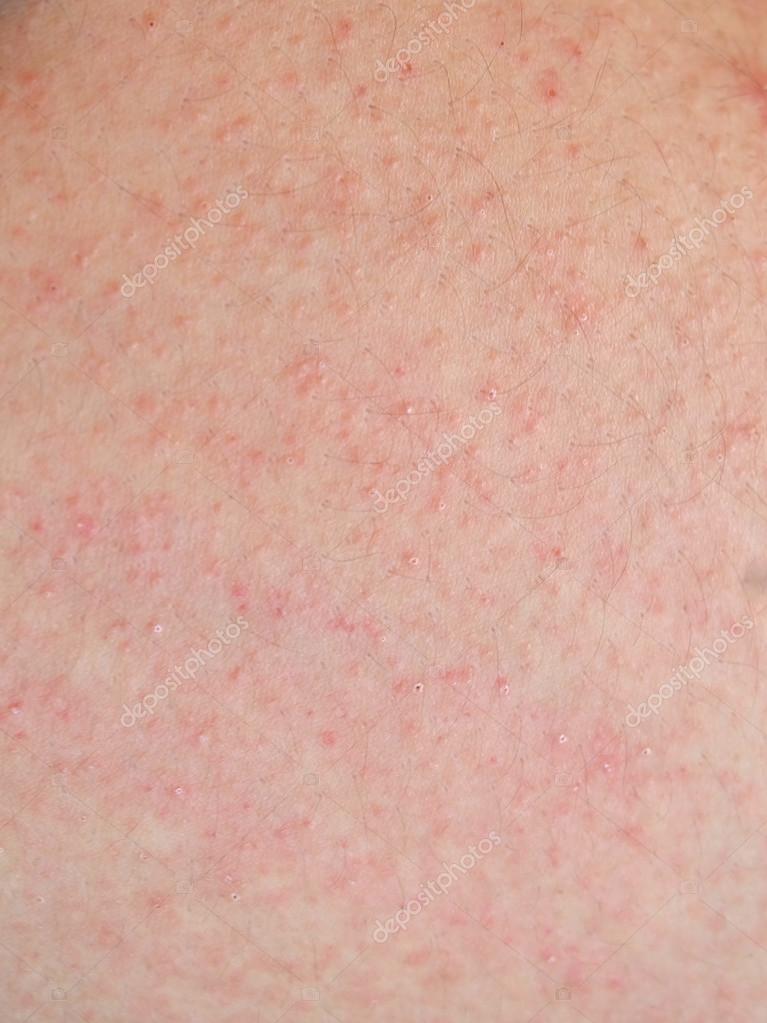 Allergic Rash Dermatitis Skin Of Patient Stock Photo By C Nattapol
