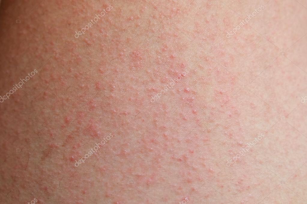 allergiska utslag bilder allergiska utslag bilder