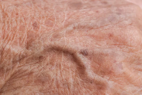 Old woman skin blood vessel — Stock Photo, Image