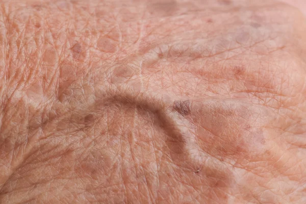 Old woman skin blood vessel — Stock Photo, Image