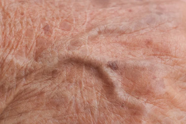 Mulher velha pele vaso sanguíneo — Fotografia de Stock